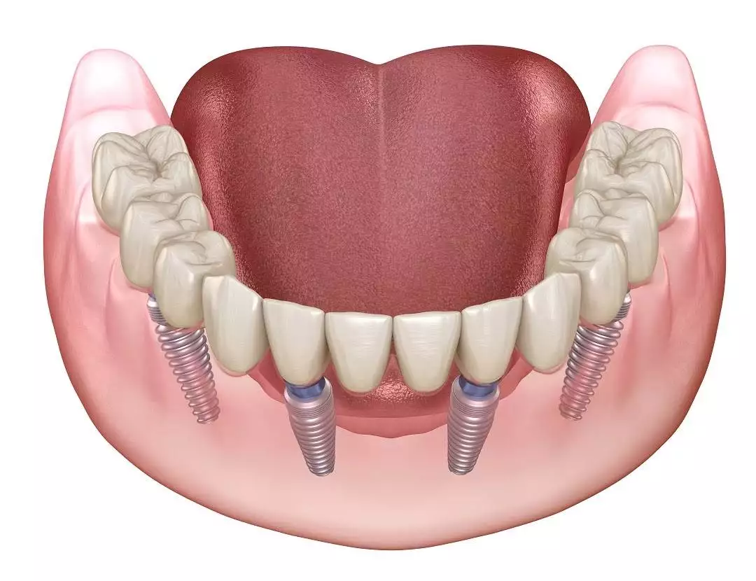 Full Mouth Rehabilitation in Gurugram