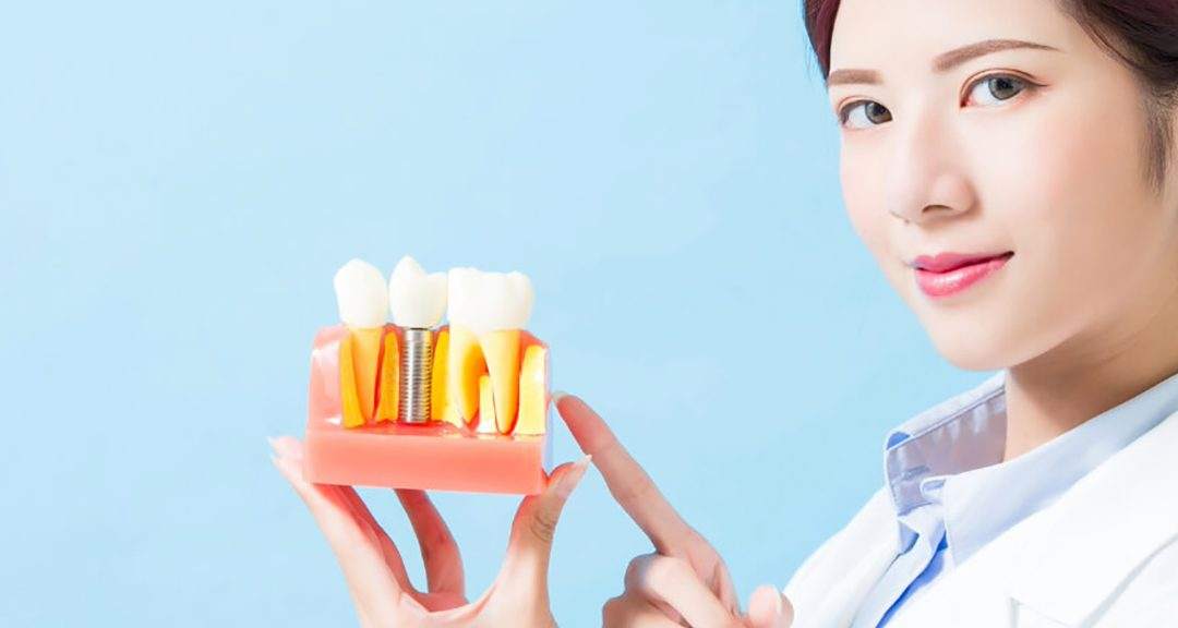 Dental Implants 101: Everything You Need to Know