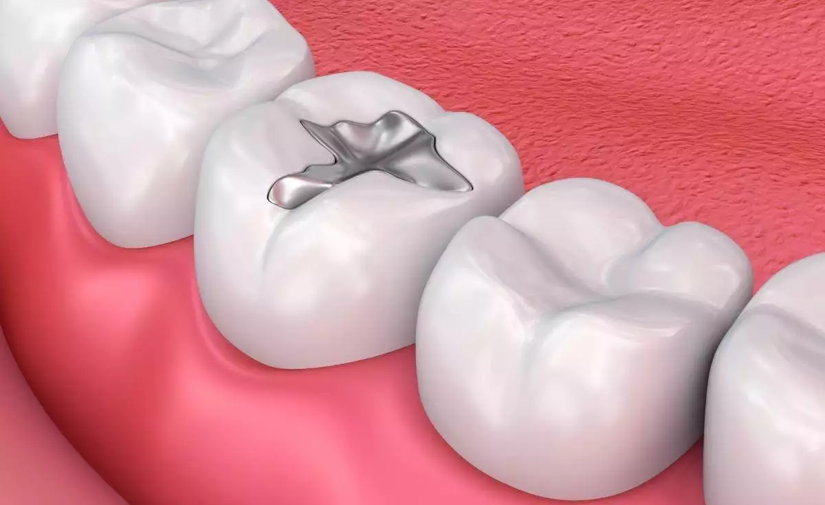Dental Fillings In Gurugram