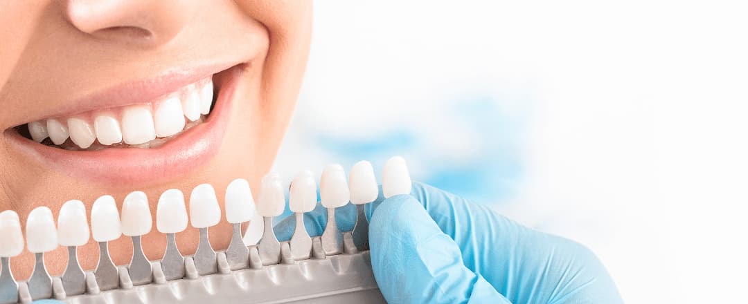 The Secret to Whiter Teeth: Professional vs. At-Home Whitening