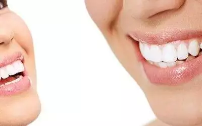 The Ultimate Guide to Achieving a Radiant Smile