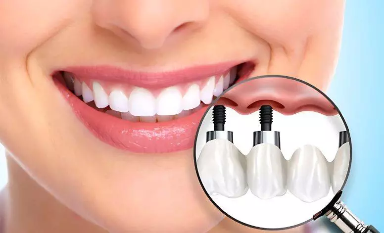 Dental Implants Treatment in Gurugram Dental Implants Treatment in Gurugram