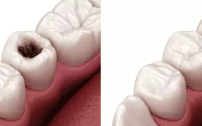 Cavities and Fillings: What Causes Them and How to Prevent Tooth Decay