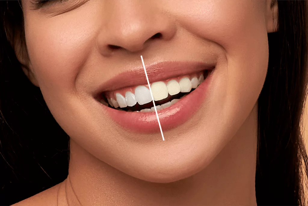 Teeth Whitening in Gurugram Teeth Whitening in Gurugram