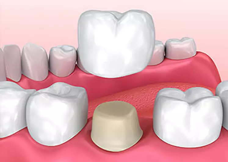 Dental Crowns in Gurugram Dental Crowns in Gurugram