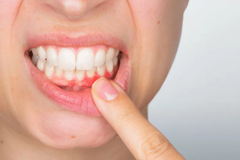 Gum Treatment in Gurugram Gum Treatment in Gurugram