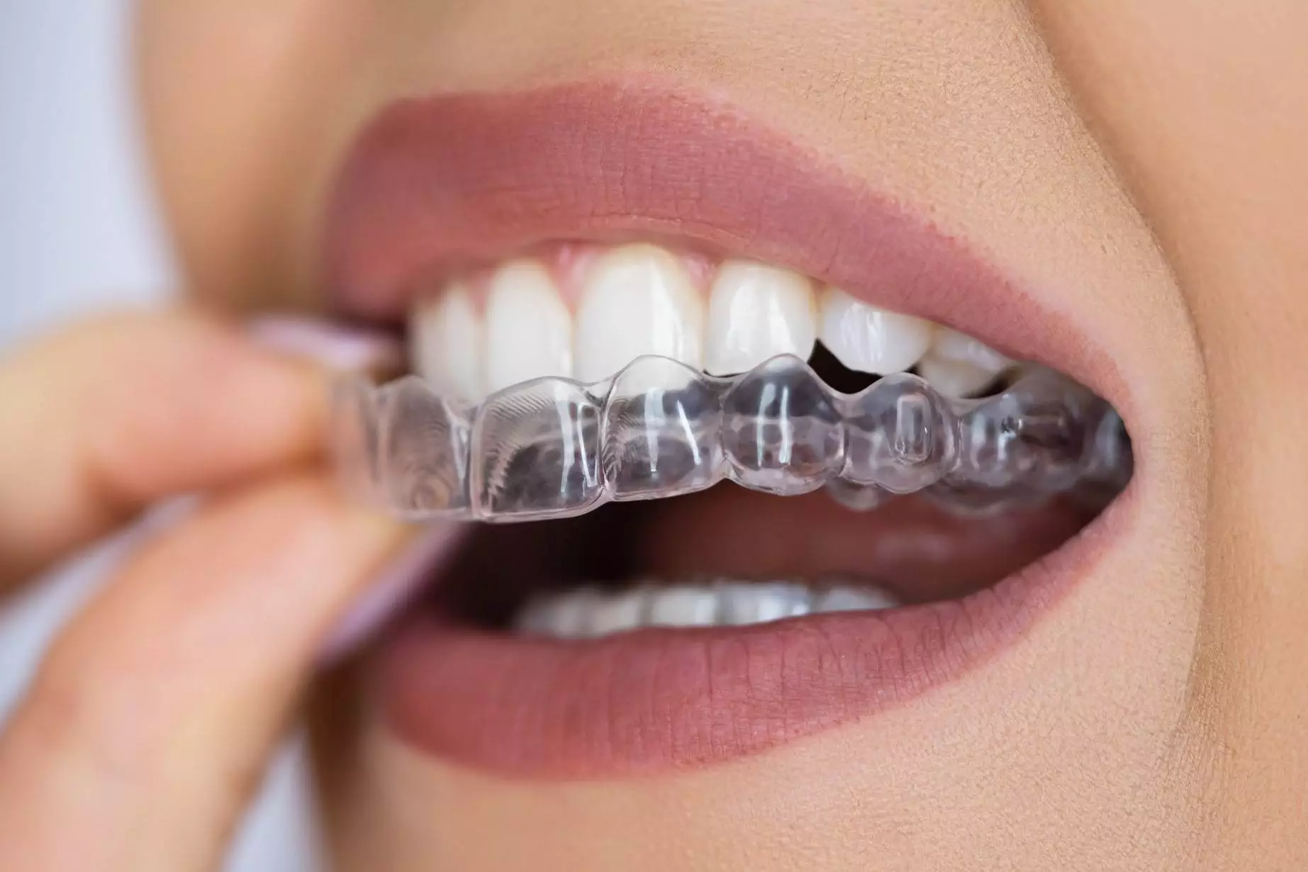 Invisible Braces in Gurugram Invisible Braces in Gurugram