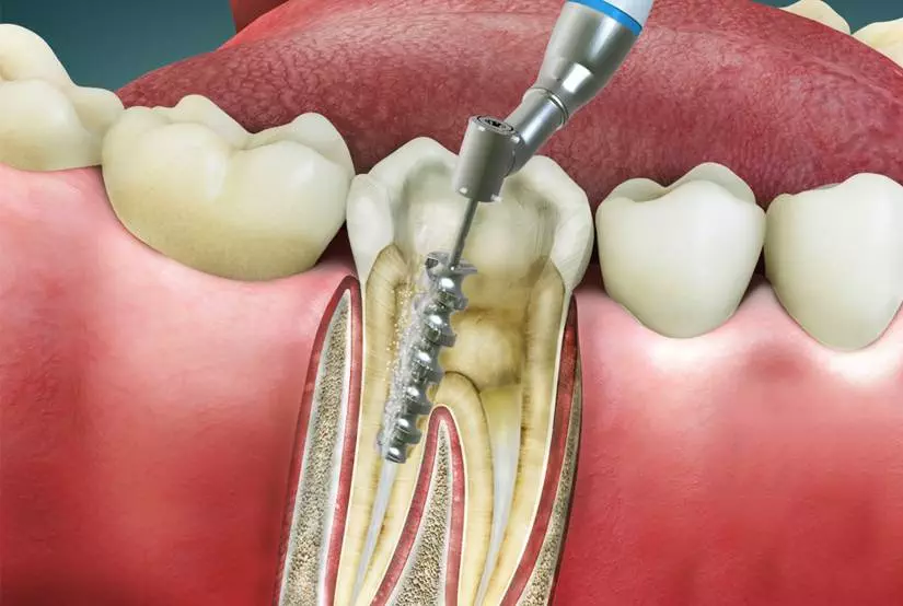 Root Canal Treatment in Gurugram Root Canal Treatment in Gurugram