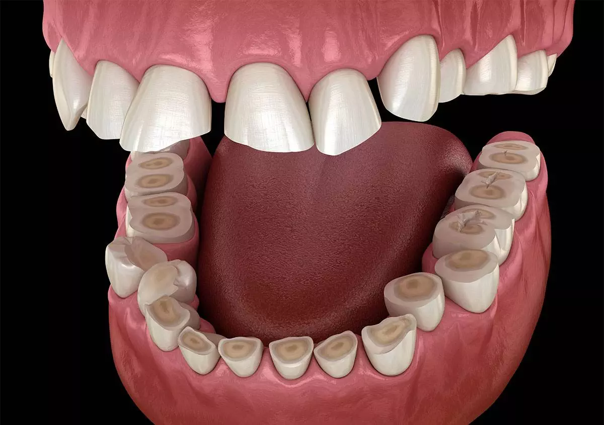 Teeth Grinding Treatment in Gurugram Teeth Grinding Treatment in Gurugram