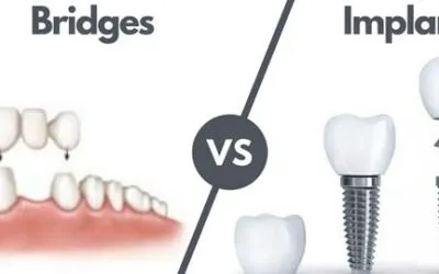 Dental Implants vs. Bridges: Which Is the Right Option for Missing Teeth?