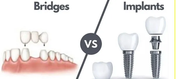 Dental Implants vs. Bridges: Which Is the Right Option for Missing Teeth?