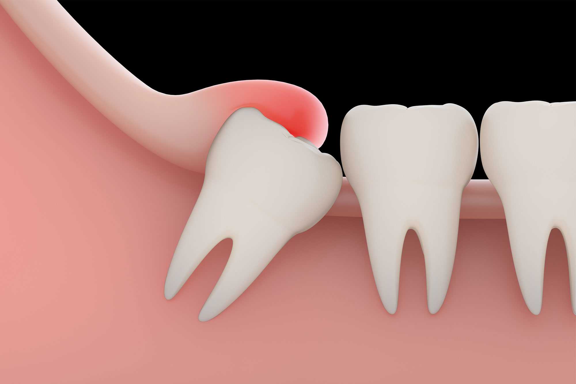 Wisdom Tooth Extraction in Gurugram
